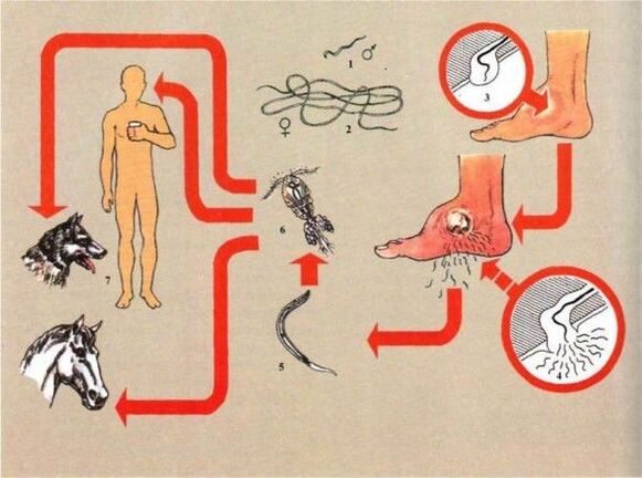 Entwicklung einer Dracunculiasis